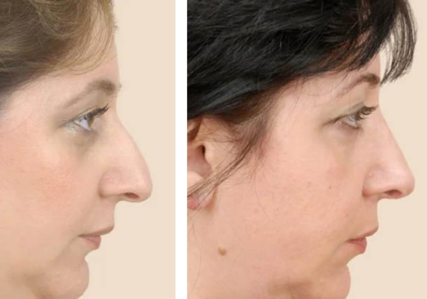 Rhinoplasty Surgery